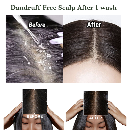 Root Rituals Anti Dandruff Kit | Hair oil, Anti Dandruff Shampoo & Anti Dandruff Serum