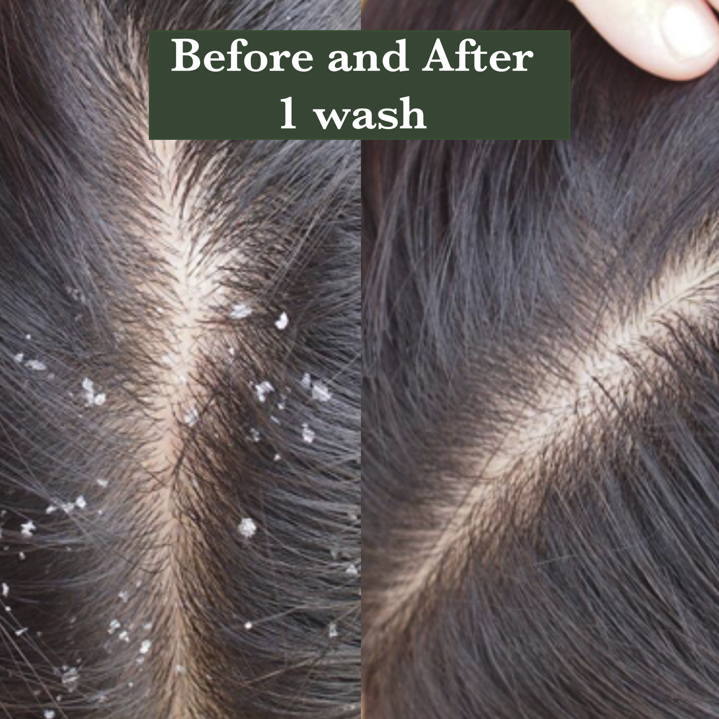 Root Rituals Anti Dandruff Kit | Hair oil, Anti Dandruff Shampoo & Anti Dandruff Serum